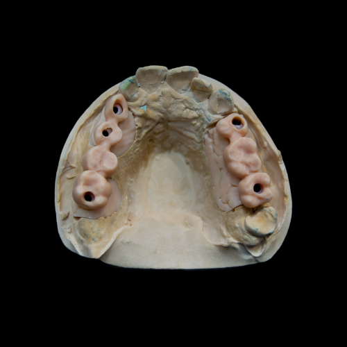 gedruckte einbringhilfe für gefräßte abudments gedruckte Einbringhilfe für gefräßte Abutments
